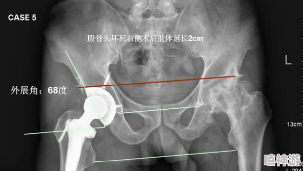 八爪鱼紧缩术：最新研究显示该手术在减重效果和安全性方面取得显著进展，受到广泛关注与应用